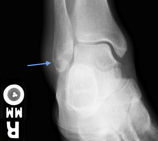Weber A Fracture (Zoomed Image)