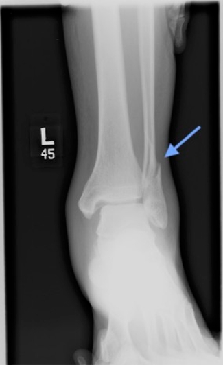 Weber A Fracture (Zoomed Image)
