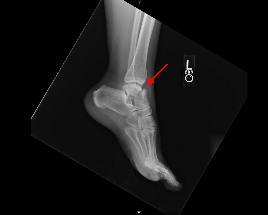 talus fracture with arrow
