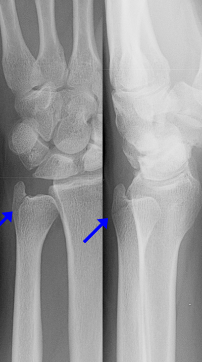 styloid process of ulna fracture