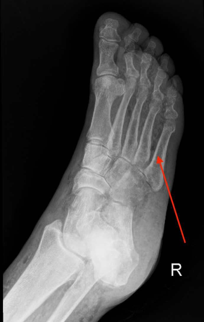 necrotizing fasciitis xray foot